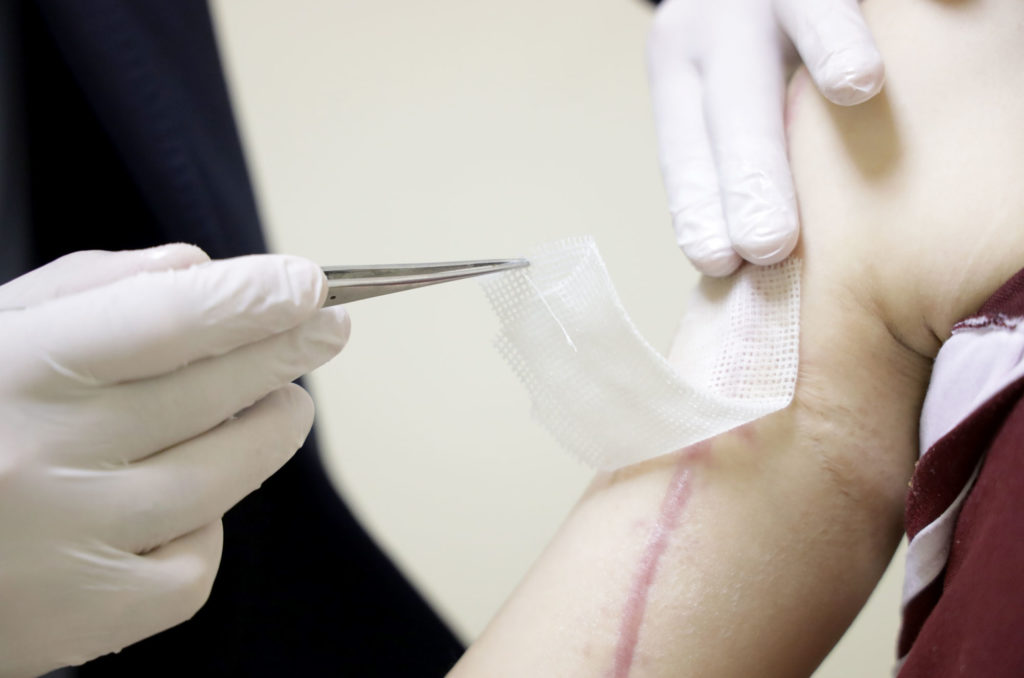 health, medical-aid, lebanon, beirut-blast, burn-patients, burn-pads Removing a burn pad from scarred tissue.