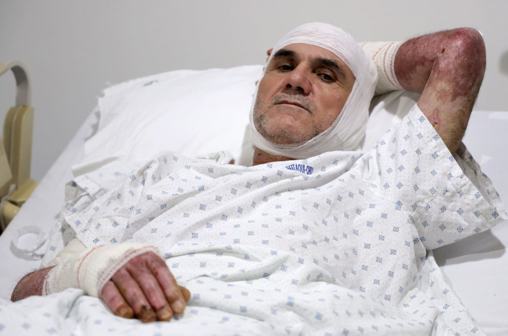 Samir in his hospital bed with visible burn scars on his arms.